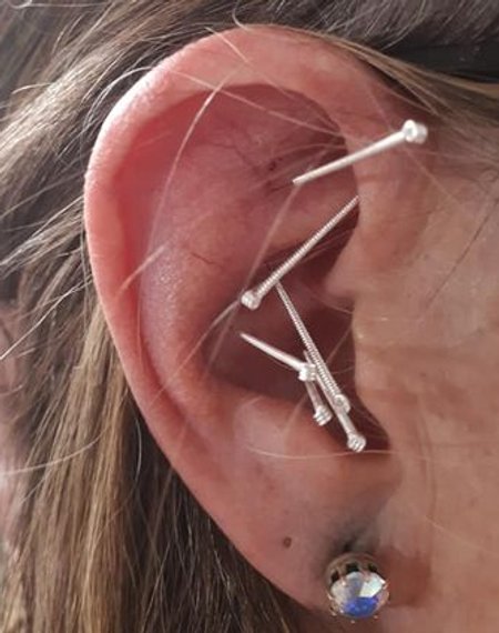 Bilden visar exempel på hur man sätter akupunktur nålar i örat enligt Herb Pharma Naturterapi